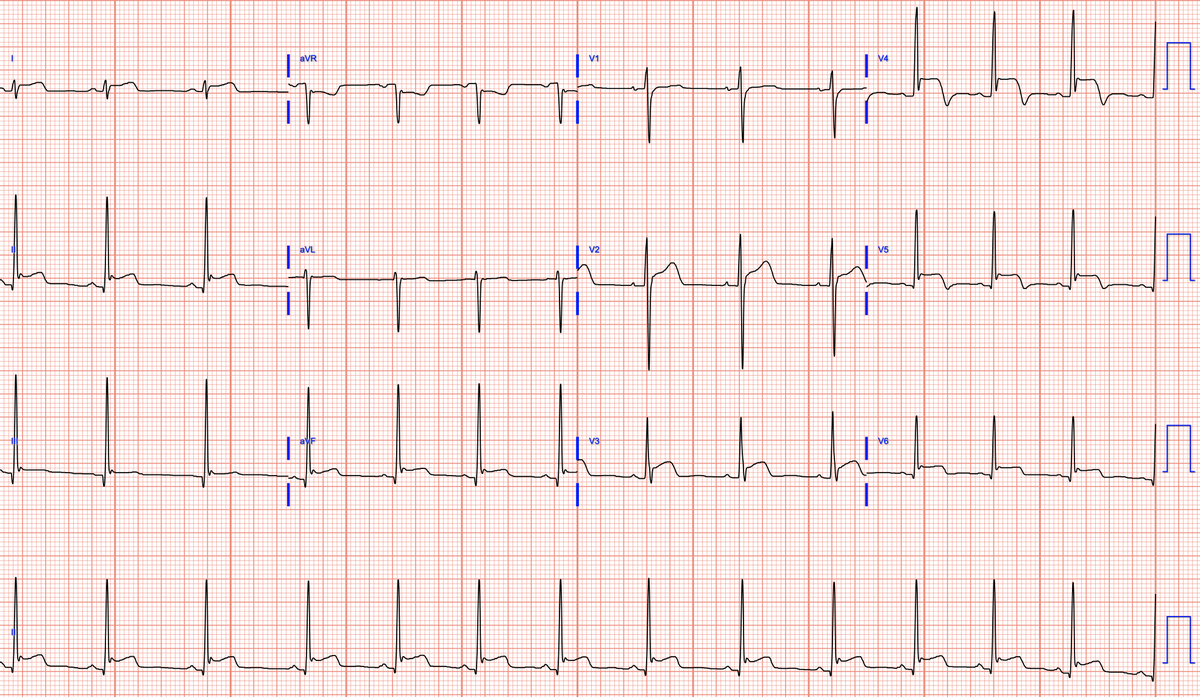 Jeffrey M Vinocur (@jeffrey_vinocur) on Twitter photo Chest pain and ST elevation, in sequence
<a href="/RobertHermanMD/">Robert Herman, MD, PhD</a> <a href="/smithECGBlog/">Stephen W. Smith</a> <a href="/EM_RESUS/">Sam Ghali, M.D.</a> <a href="/BrooksWalsh/">Brooks Walsh</a> <a href="/DidlakeDW/">David Didlake</a> Chest pain and ST elevation, in sequence
<a href="/RobertHermanMD/">Robert Herman, MD, PhD</a> <a href="/smithECGBlog/">Stephen W. Smith</a> <a href="/EM_RESUS/">Sam Ghali, M.D.</a> <a href="/BrooksWalsh/">Brooks Walsh</a> <a href="/DidlakeDW/">David Didlake</a>