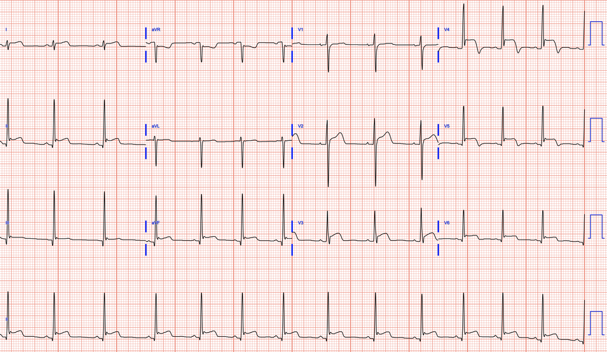 Chest pain and ST elevation, in sequence
@RobertHermanMD @smithECGBlog @EM_RESUS @BrooksWalsh @DidlakeDW