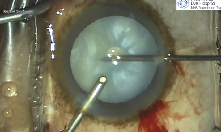 Ophthopedia Update: Automated Bimanual Decompression of Intumescent Cataract: Alternate Solution for Challenging Cases dlvr.it/T646qW #Ophthalmology #Ophthotwitter #Scicomm
