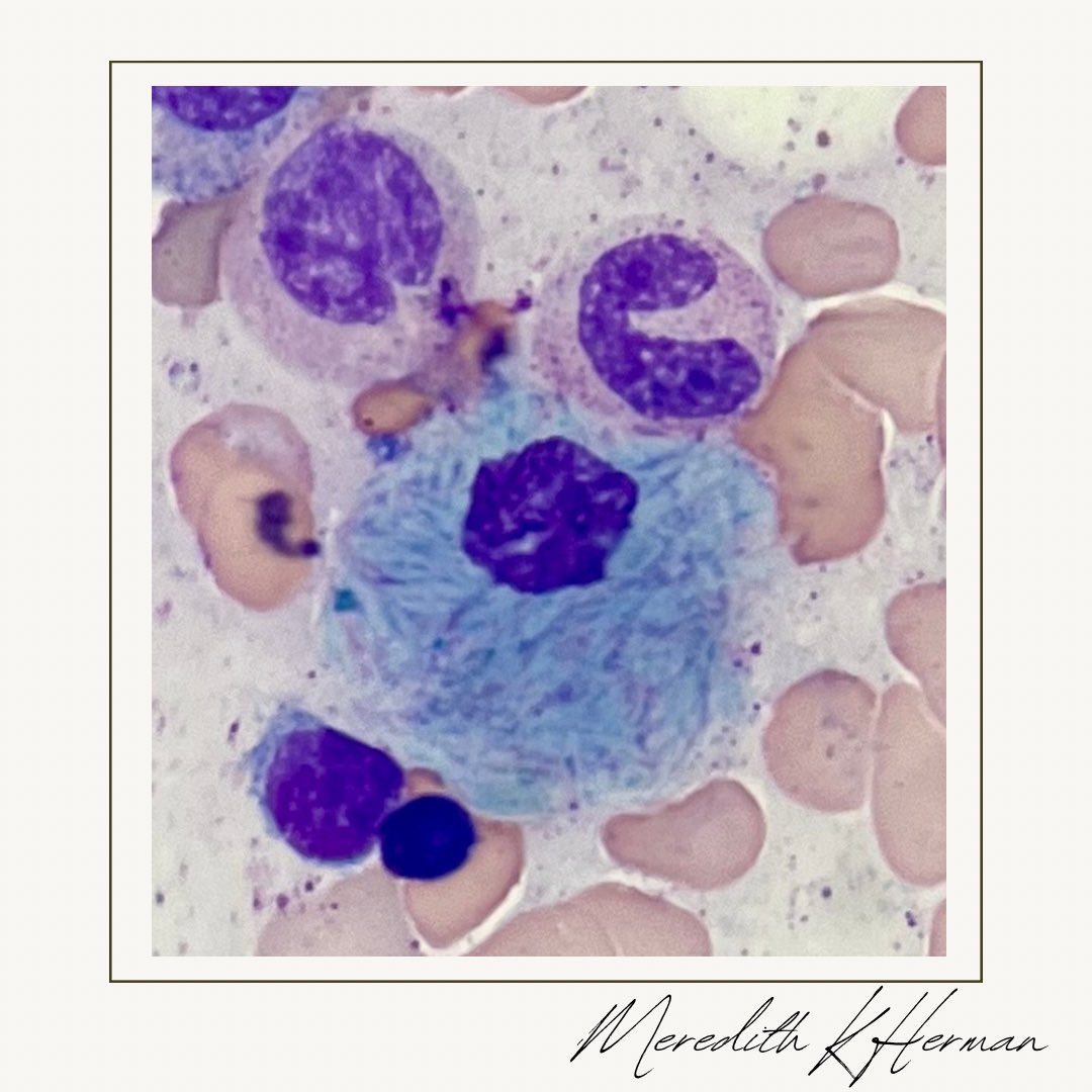 TGIF 🔬#fridayfinds #hemepath #PathX 
Sea-blue histiocyte or gaucher?

The blue is quite striking! 

⭐️Bonus: what heme malignancy should you be worried about?