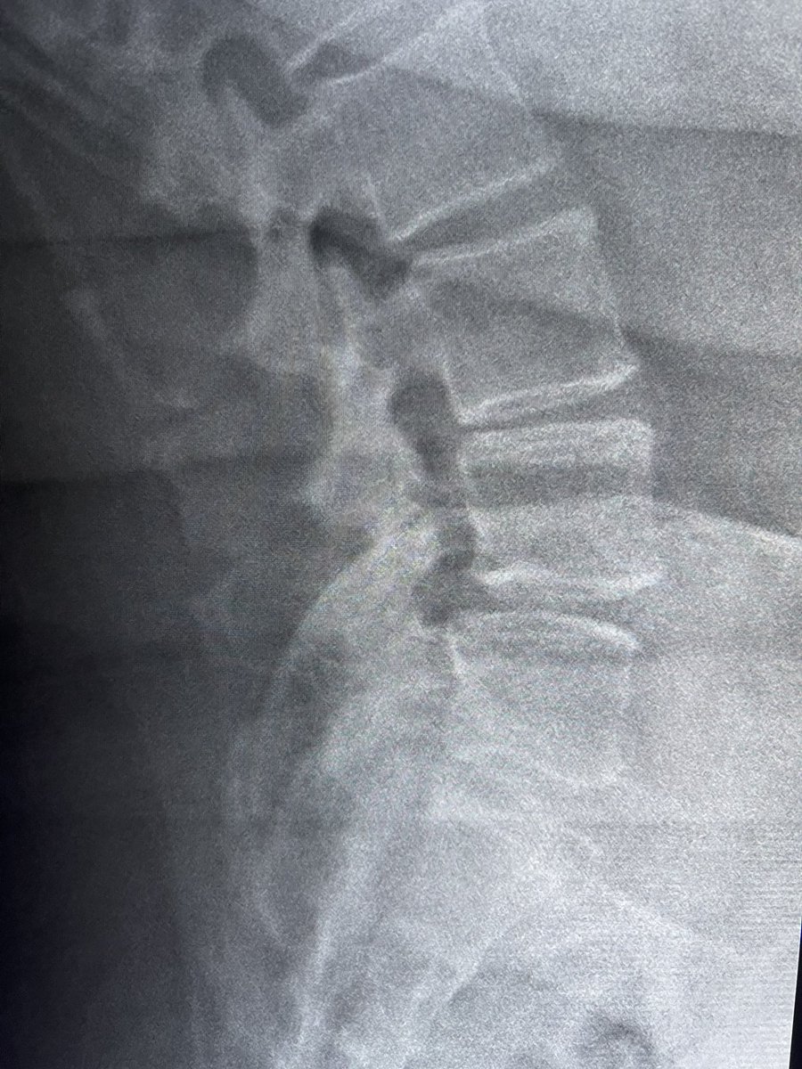 More #MSKIR in a woman who has back pain and neurogenic claudication. 

#MRI demonstrates central canal stenosis. Flex/ex revealed anterolisthesis and mild sagittal instability. 

#Minuteman by @SpinalSimpLLC 

🧵…