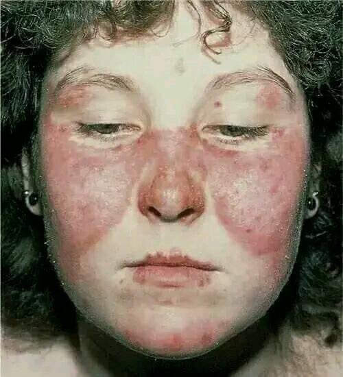 #CTD

What is the diagnosis?

#MedEd 
#MEDHM 
#MedX 
@IhabFathiSulima