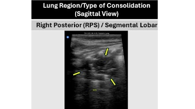 Dataset of lung ultrasound acquired with a #POCUS device in Zambian children with clinical symptoms of pneumonia doi.org/10.1148/ryai.2… @BUSPH @The_BMC @MCG_AUG #PedsRad #AI #MachineLearning