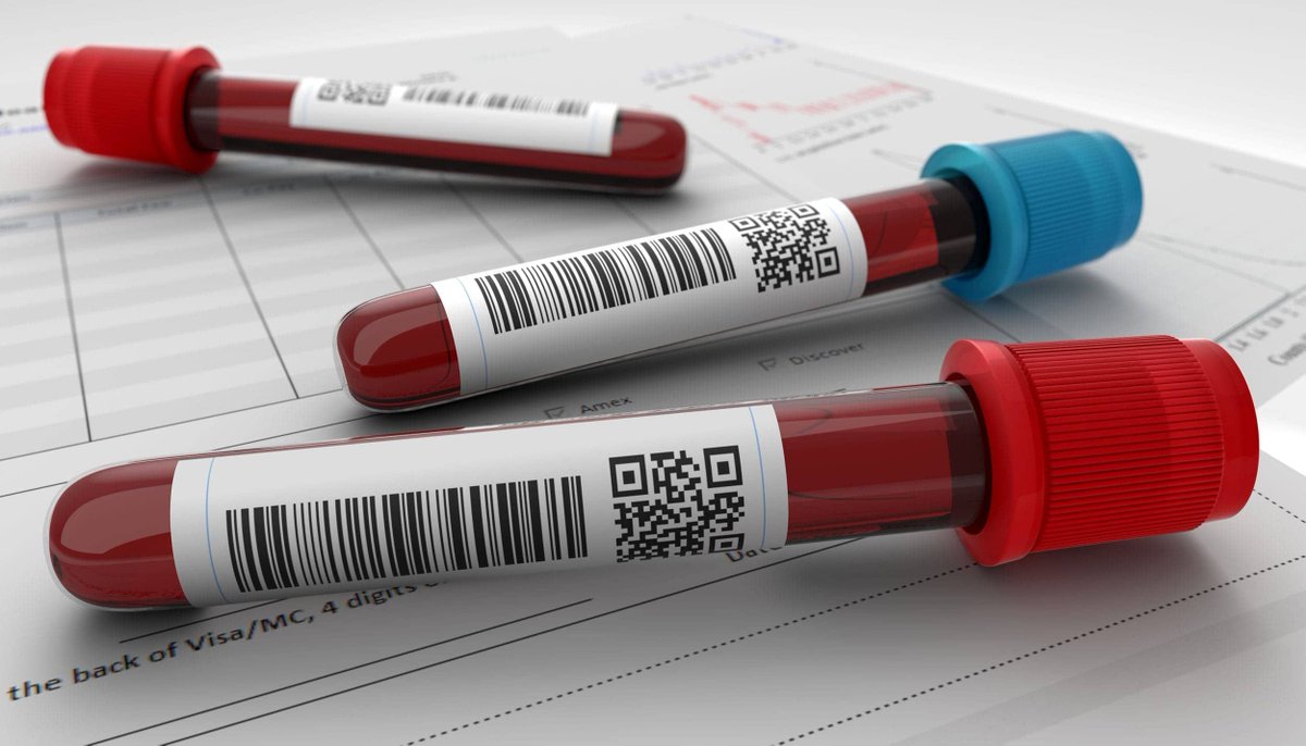 Researchers developed a blood test that can predict the onset of knee osteoarthritis up to eight years before it is visible on X-rays. Read here: buff.ly/3UdWVO5 #bloodtest #osteoarthritis #liquidbiopsy #arthritis