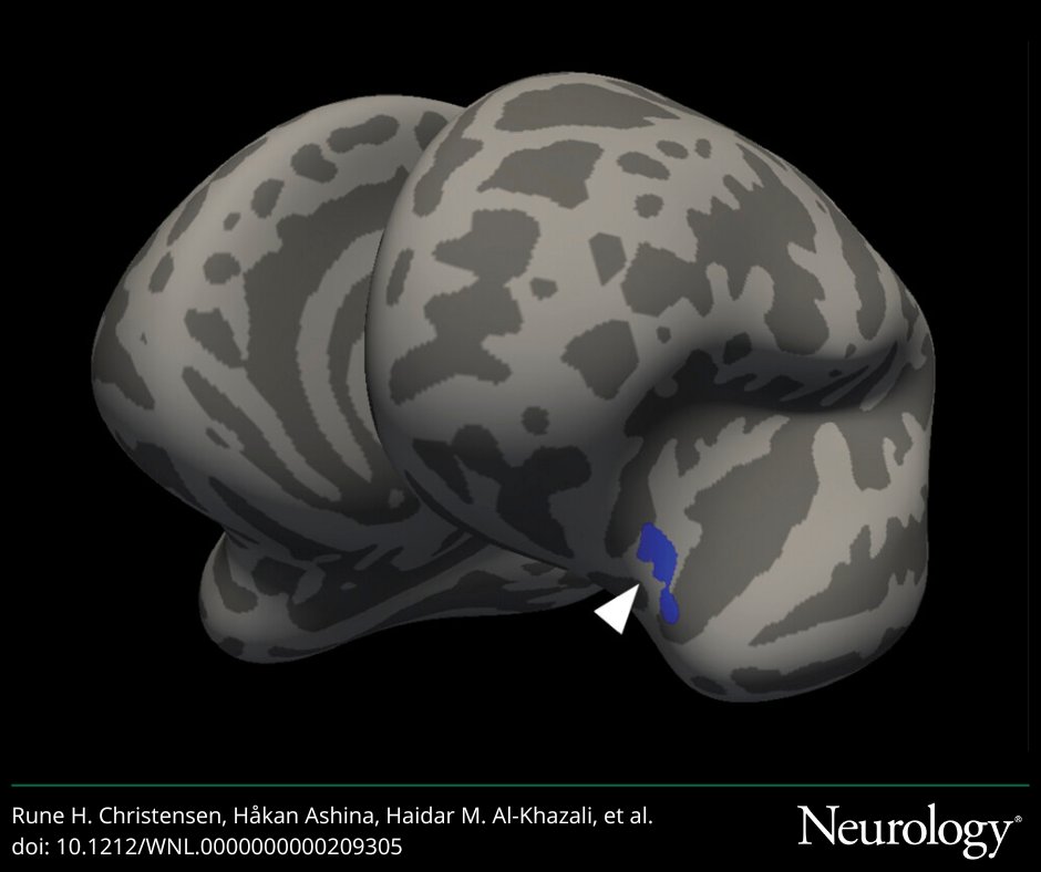GreenJournal's tweet photo. Study findings suggest that migraine is associated with cortical morphology differences specifically in pain processing regions of the cortex: https://t.co/wZzUxFPOSK

#NeuroTwitter #headache https://t.co/CengxQcElU