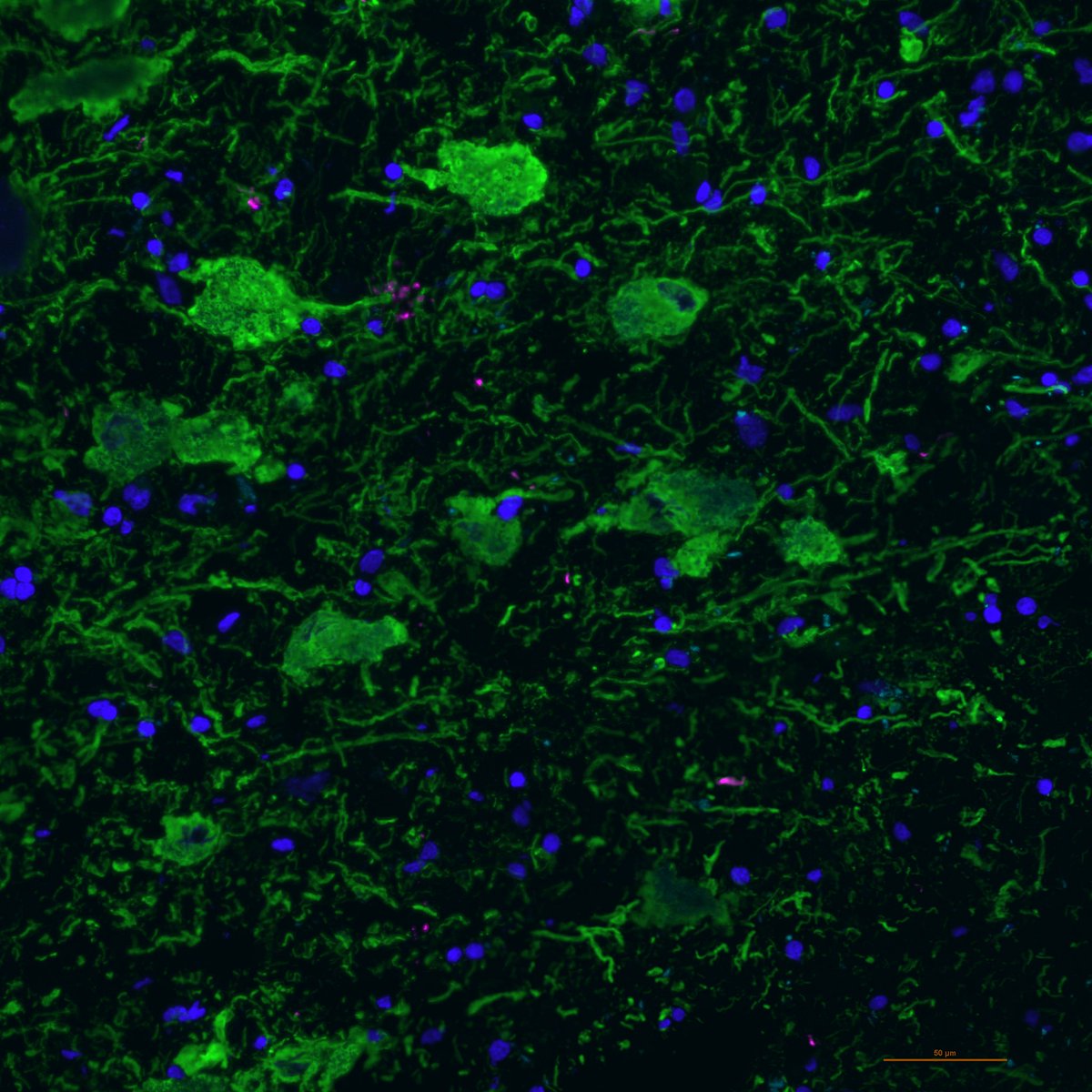 Some HUGE norepinephrine neurons in the human locus coeruleus, marked by tyrosine hydroxylase TH, 🟢). Image credit to <a href="/HeenaDivecha/">Heena Divecha</a> #FluorescenceFriday 🧠🔬💙