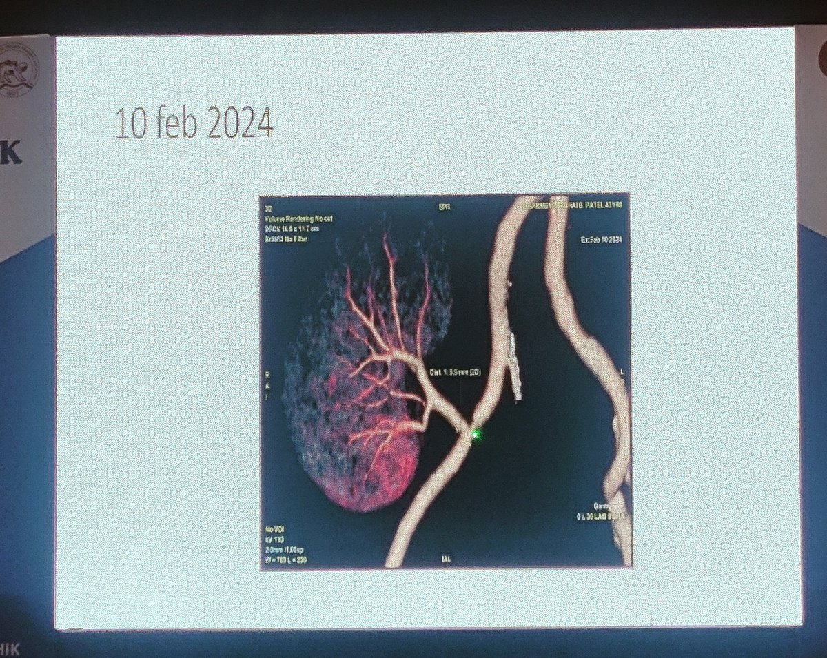 Tx RAS by Dr Shishir Gang #ISOTMIDTERM 🔥 Suspect if PSV> 180 or RI < 0.5 🔥 W shaped reverse wave in transplant renal vein - look for RVT 🔥Pseudoaneurysm RA- r/o infection - nephrectomy may be needed 🔥 PseudoTRAS r/o clamp injury, donor atheroma