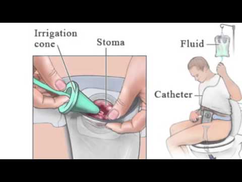 “Colostomy irrigation“
Check out this great stream of posts - all the 2018-2024 discussion: 
☛ meetanostomate.org/discussion-for……
-------------------------- 
#ostomy #stoma #wocn #ostomyforum #ostomytips #colorectalsurgery