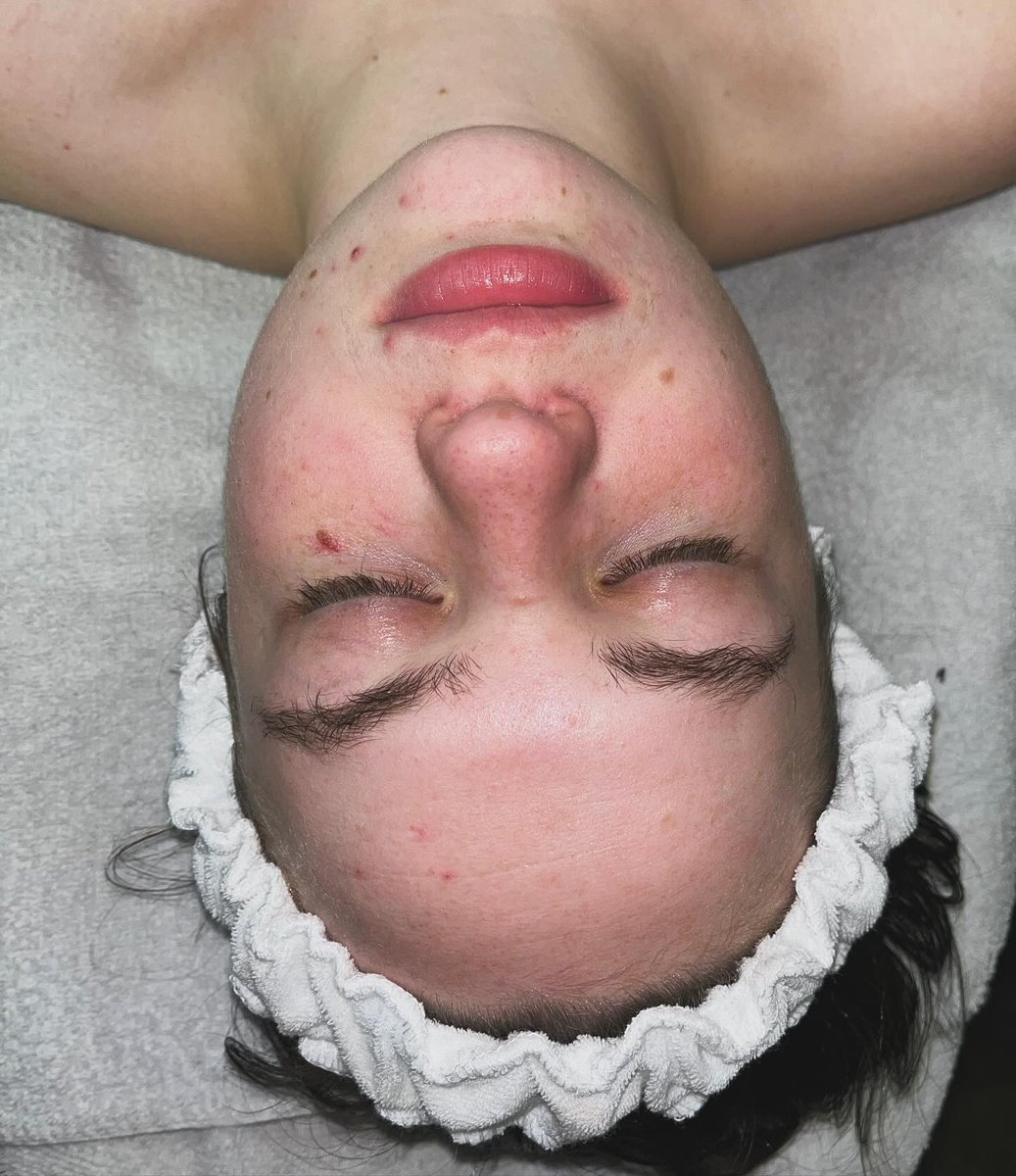 Makshroomm's tweet photo. Did my first facial this week at school! Her skin is now ✨glowing✨ Kate thank you for being an amazing first client!! #esthetician #firstfacial #esthticanstudent #dermalogicaschool #dermatoloica https://t.co/XjphmHn0ht