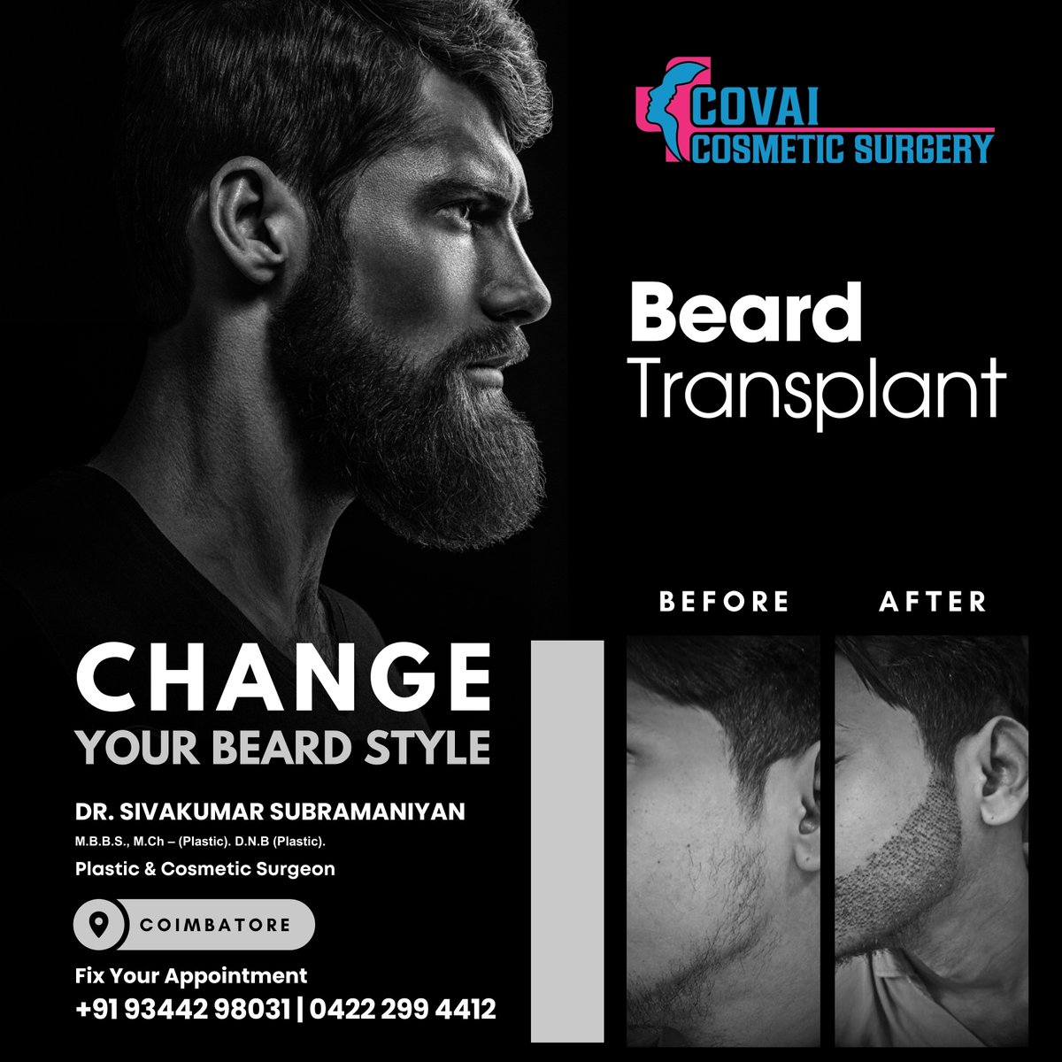 Are you looking for the perfect beard? Covai Cosmetic Surgery Hair Transplant can help ideal bread. Say goodbye to patchy spots and hello to confidence. Start your journey today.

#beard #beardlove #beardlife #bearded #beardstyle #beardchallenge #beardtransplant #beardtransplants