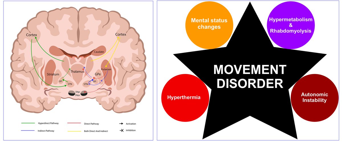 Movement Disorder Emergencies 

#FOAMed #movementdisorders #neuroemergent #parkinsonism #neuroleptics #catatonia #dystonia #serotoninsyndrome