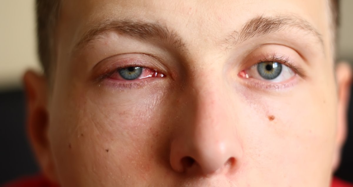 Pink eye can be highly contagious, spreading rapidly in schools and day-care centers, but it’s rarely serious. Find out the types of pink eye and treatments: wb.md/3vYVX05
