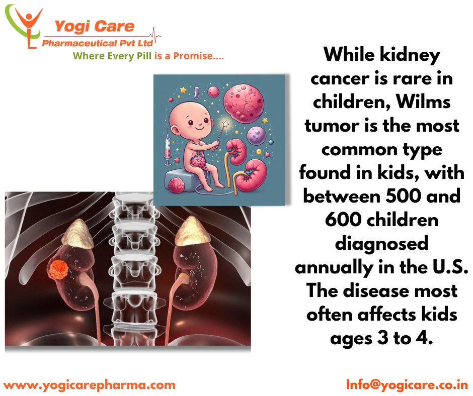 🌟 Wilms tumor: common kidney cancer in kids under Five. Symptoms include abdominal swelling, pain, fever. Genetic factors play a role. Stay informed! 🧬 #WilmsTumor #QualityMedicine”

Stay tuned for updates! 📸👀
 #DailyUpdate #Pharma