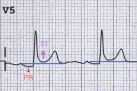 ECG spot Diagnosis. Case 10. 37yrs F with a history of systemic lupus erythematosus presents with sharp chest pain, worse with inspiration and gets better when she leans forward. 1. Diagnosis? 2. What other paraclinical exam will you request? 3. Treatment?