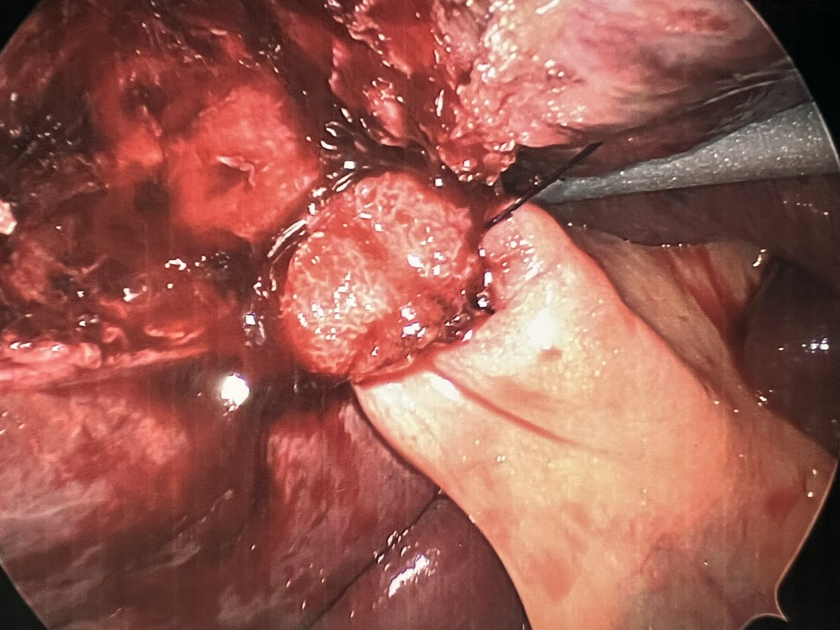 Laparoscopic Cholecystectomy for acute intra-hepatic cholecystitis. 
Top down dissection leaving an intact shield of McElmoyle.