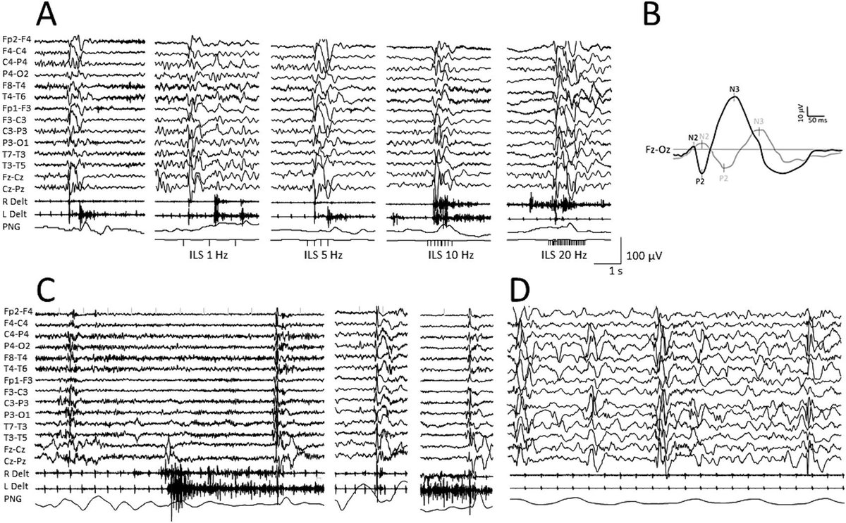 [Epilepsy] Caputo et al.: 'We report the unusual electroclinical features observed at the onset of the disease in a child, carrying a pathogenic, de novo, p.Arg559ter variant in the CDKL5 gene.' doi.org/10.1016/j.clin…