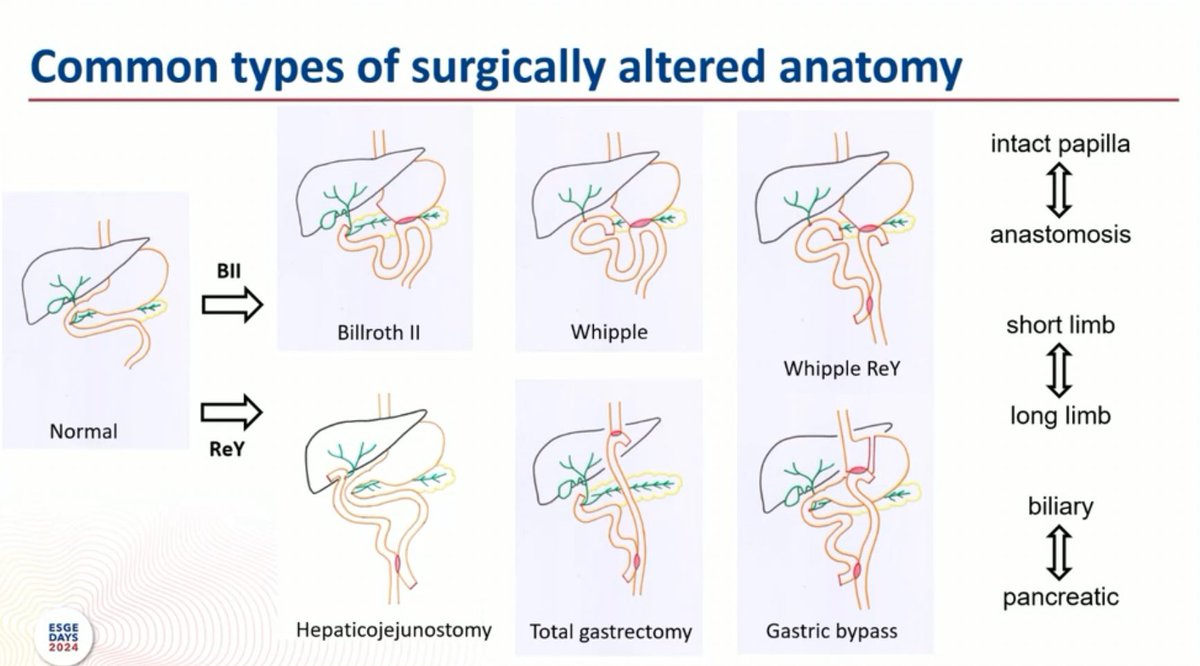 Altered anatomy which may be relevant during ERCP #ESGEDays2024