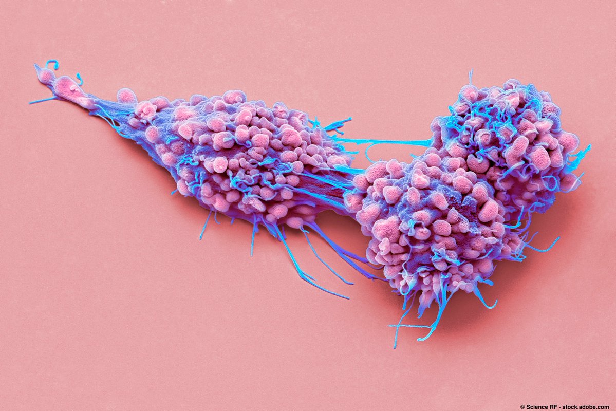 Preliminary data for CRX100 indicate that this treatment could alter the tumor microenvironment to improve responses to other therapies in patients with recurrent, platinum-resistant ovarian cancer. <a href="/StanfordMed/">Stanford Medicine</a> #ovca #oncology onclive.com/view/early-dat…