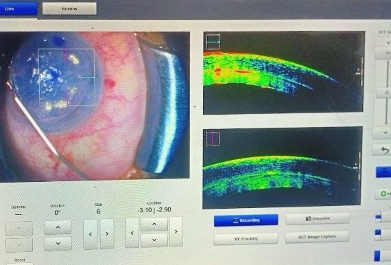 A Sutureless Corneal Transplantation (Intraop OCT guided Descemet Stripping Automated Endothelial keratoplasty) with good postoperative outcome has been successfully conducted for the first time at #INHSAsvini. @SpokespersonMoD @HQ_IDS_India @indiannavy @IndiannavyMedia