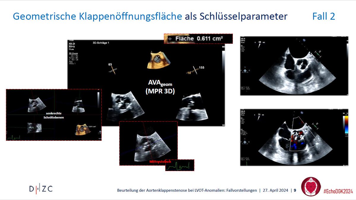 #EchoDGK2024 by @DGK_org in Leipzig Die Beurteilung der Aortenklappenstenose bei LVOT-Anomalien 🗣️ @eromerodorta @NMerke @AndreasHelfen @FabianKnebel @EchoBielefeld @KardiologieHH @YoungDZHK @dhzcharite @AGIKinterv @YoungDgk @UKL_Leipzig