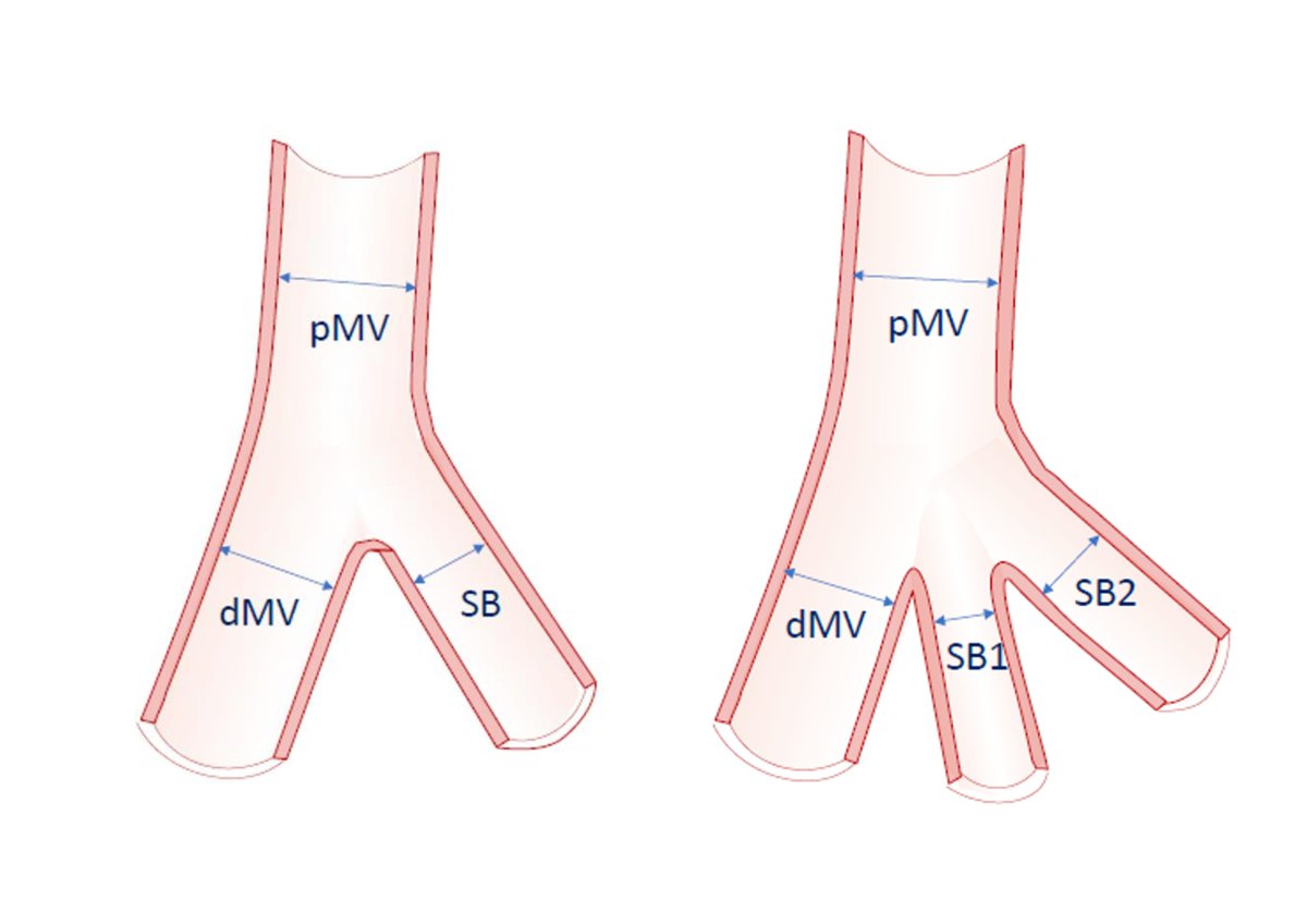 We are very proud to announce the launch of the EBC Heart Branch Diameter Calculator for Bifurcation and Trifurcation👉bifurc.eu/ebc-diameter-c… - many thanks to @YChatzizisis at the @umiamimedicine @GoranEBC @BURZOTTA_F @alaide_chief @twj1974 @RemoAlbiero #cardio