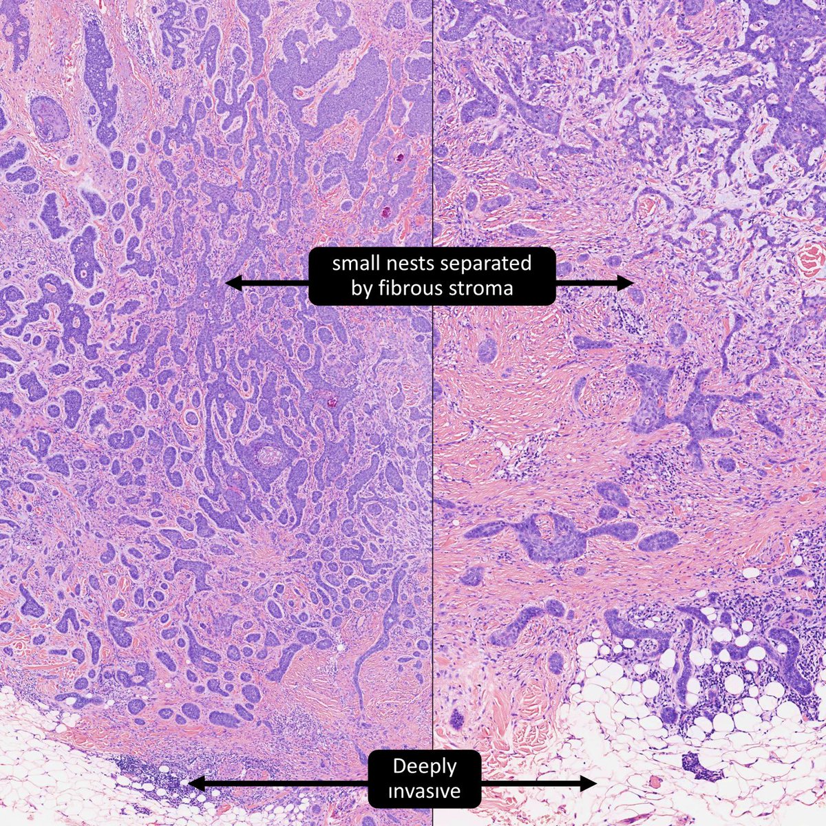 #1 of 3: Basa Cell Carcinoma, Nodular or Micronodular?
#dermpath #pathology #dermatology #pathtwitter #bstpath
🔬tumourclassification.iarc.who.int/Viewer/Index2?…