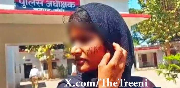 Lakhimpur, UP: Mohd Aman Hussain wrote his name 'AMAN' on the cheeks of a girl using hot iron rod and then πaqed her for refusing to accept his marriage proposal.

According to the victim girl, Aman had been pressuring her to marry him, and his mother and sister also supported