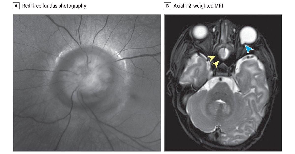 Most viewed in the last 7 days from @JAMAophth: A 2-week-old newborn was referred to a pediatric ophthalmology department for divergent strabismus. The infant had a superior cleft lip, hypertelorism, and a morning glory disc anomaly in the left eye. ja.ma/4aRVLPo