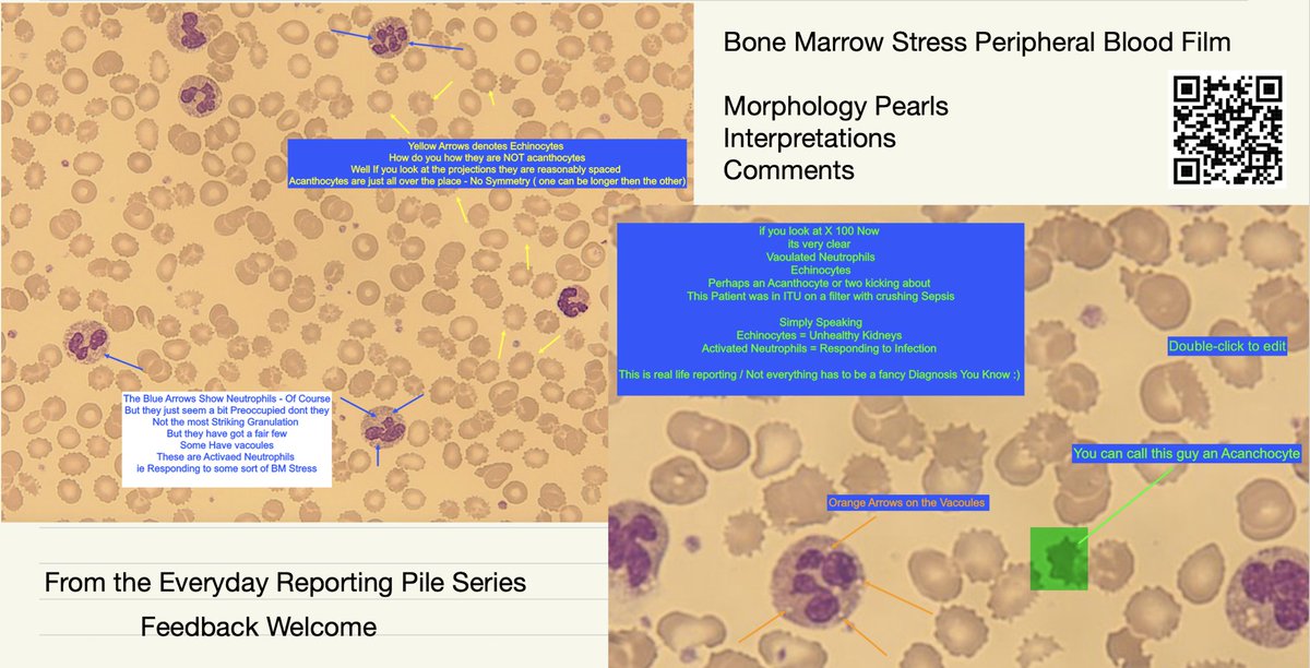 Weekend Morphology Pearl 👇👇
BM Stress 
#hematology #NEETPG #MedTwitter #MedX #medicine