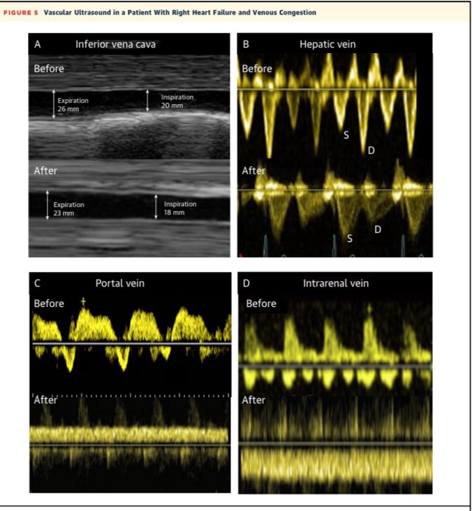 🩺Assessment of Venous Congestion Using Vascular Ultrasound Evaluation of the hepatic, portal, and intrarenal vein flow patterns (VEXUS) may help to identify venous congestion at an earlier stage and could be useful to optimize fluid management. sciencedirect.com/science/articl…