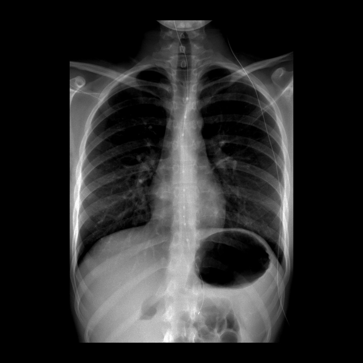 Teen with symptoms of gastroesophageal reflux

CXR shows an esophageal pH probe. Position of esophageal pH probe sensor / measurement lead (radiolucent cylinder with radiopaque stripe in center of it) is 3-5 cm above gastroesophageal junction.

#FOAMed #MedEd #FOAMRad #PedsRad