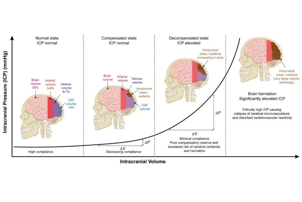 The Monro-Kellie doctrine: How does the body compensate for space occupying lesions? And when does it reach its limit?

@AANSNeuro @The_SBNS @neurosurgatlas @TheJNS @neurosurgery @AOSpine

#MedTwitter #MedEd #Neurosurgery #Brain #Spine