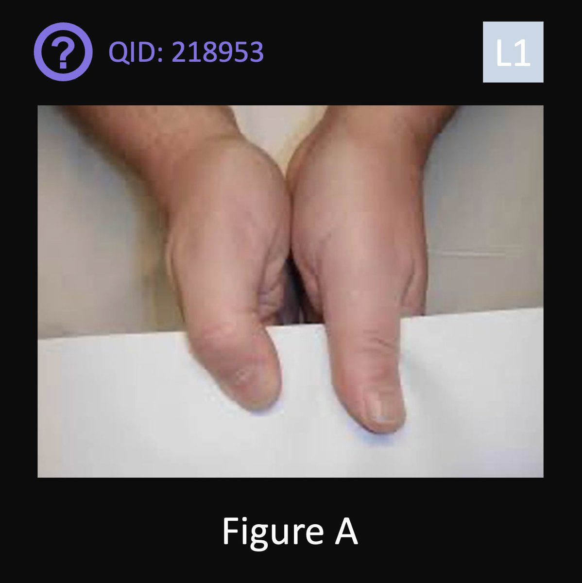 orthobullets's tweet image. Can you answer this daily question from our Free QBank correctly?
QID: 218953
Comment your answer below, then check to see if you got it correct by clicking the link below to see the answer & explanation.
bit.ly/3Wjcq9Z
#orthotwitter #MedTwitter