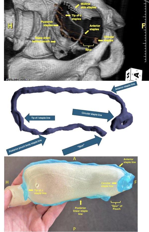 3D #Pouch Reconstruction: A Breakthrough in Visualizing #IPAA Anatomy and Pathology @HolubarStefan @IBD_FloMD @MRegueiroMD academic.oup.com/ecco-jcc/advan…