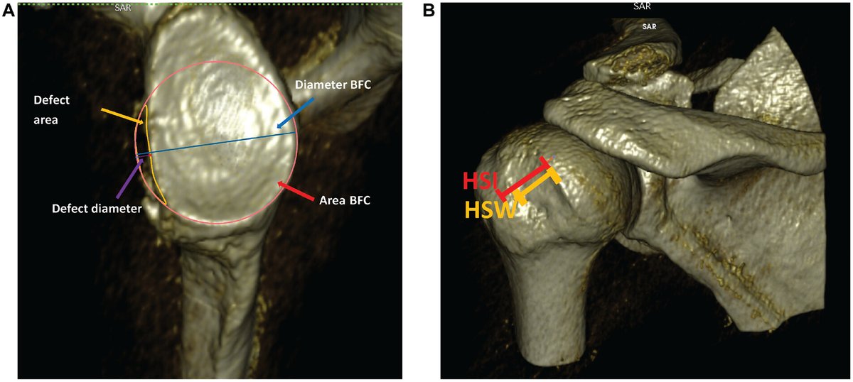 The use of automated software increases the reliability of humeral head measurements in chronic anterior shoulder instability. @ChariteBerlin ow.ly/RzNV50Row0l
