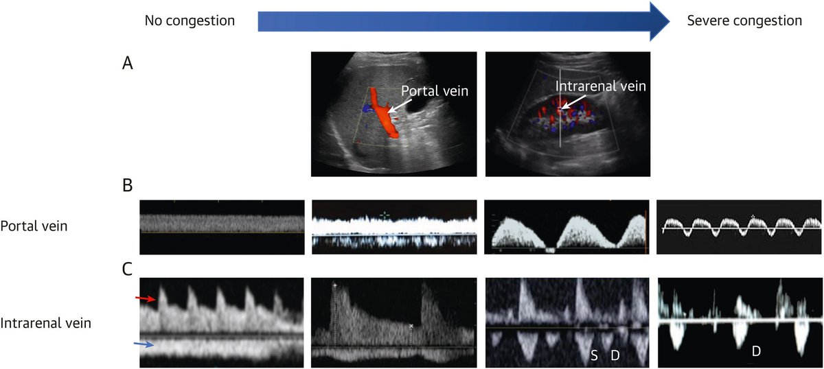 🔴 Assessment of Venous Congestion Using Vascular Ultrasound #OpenAccess #2023review 

sciencedirect.com/science/articl…
#MedX #MedTwitter #CardioTwitter
 #MedEd #cardiotwitter #FOAMed #CardioEd #Cardiology #MedEd #ENARM #cardiotwiteros #meded #cardiology #CardioTwitter #CardioEd