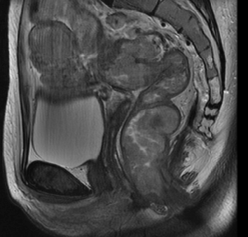 What familial adenomatous polyposis looks like on rectal MRI