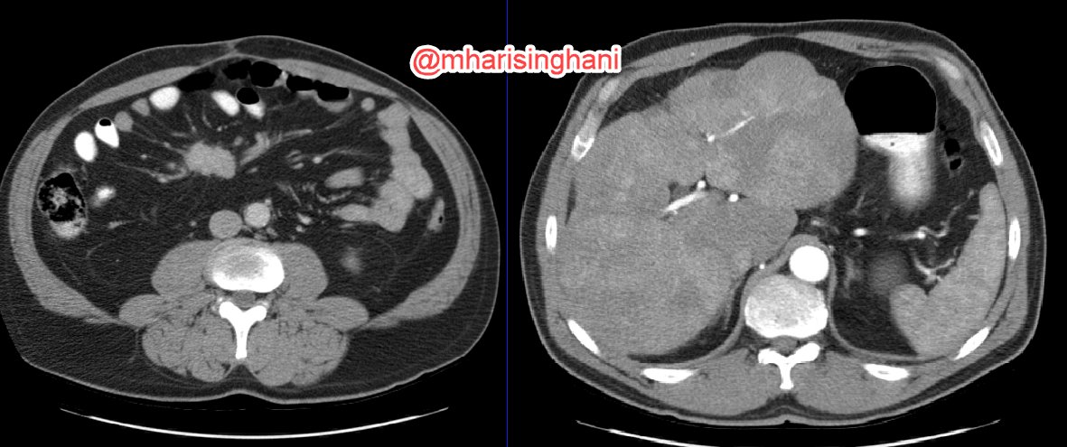 What small bowel carcinoid metastases looks like