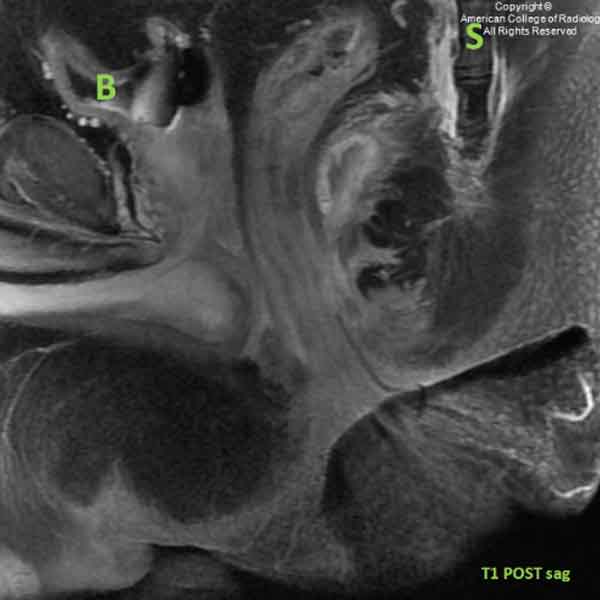 A 59-year-old man with previous trauma to the lower lumbar region from a motor vehicle accident presents with lower back pain. #ACRCaseinPoint bit.ly/3viZsOB