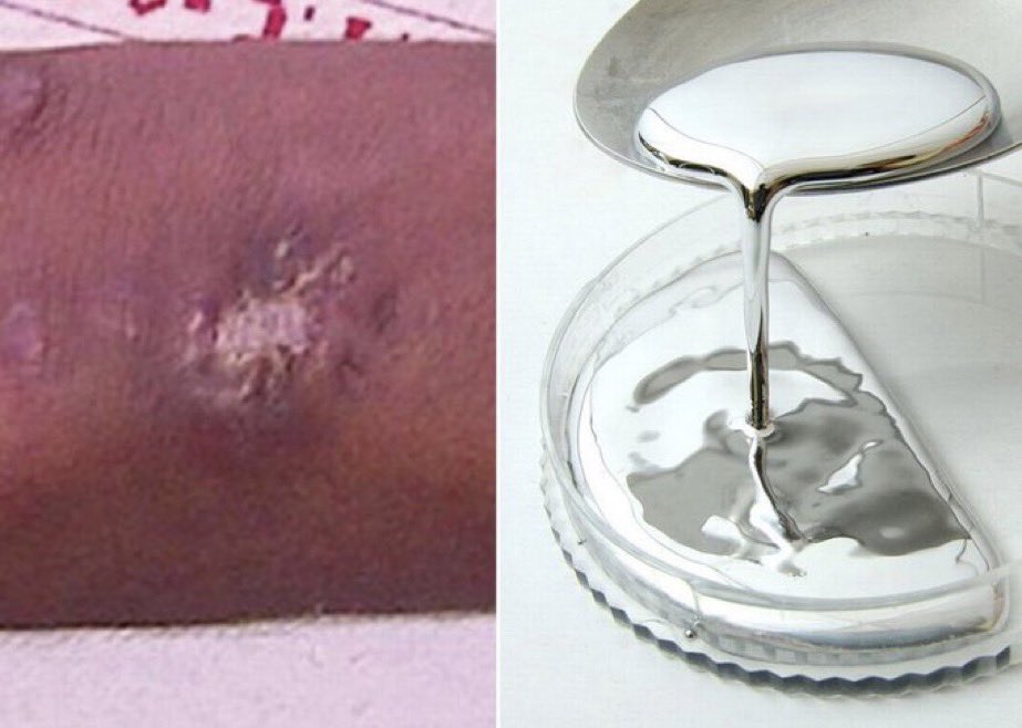MorbidKnowledge's tweet photo. In 2014, a 14-year-old injected himself with mercury at least 3 times, in an attempt to convert his bones into metal after seeing the movie Wolverine. He also intentionally got bitten by spiders on multiple occasions because he wanted to be Spider-Man. https://t.co/cZmXn1urPS
