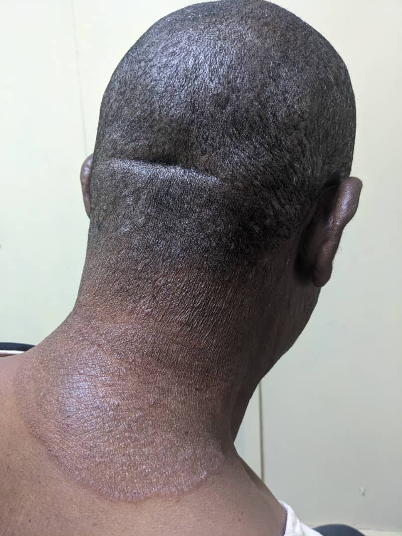 Spot diagnosis!!!
Itchy skin lesion at the hair and back of the neck,what is the diagnosis$
DD?
Treatment?
#MedTwitter #MedX #MedEd #FoaMed #Medical #clinical #Medicalstudent #dermTwitter #dermatology 
@Sthanu5 @ChiomaDPatrick @Dr_MSU @DrAkhilRaghavan @Jpraise10 @IhabFathiSulima…