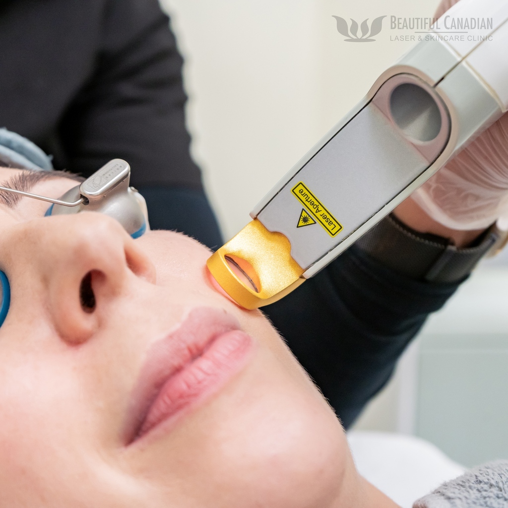 bclaser's tweet image. The excel® V uses a 532 nm KTP beam, which is just as effective, if not better at absorbing red hues than a 595 nm pulsed-dye laser (typically used for redness).
l8r.it/FvmY
#rosacea #rosaceatreatment #excelv #vascularlaser #flushing #redness #redface #ktplaser