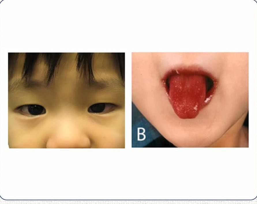 #Practice
Q.A 4-y-old boy presented with a hx of fever,conjunctival congestion,and erythematous desquamation of the skin as shown in the images below.
A 2D echo shows a coronary aneurysm.
What’s the first line of trt for his condition? 
A.IVIG
B.Aspirin
C.LMWH
D.Warfarin 
#MEDHM