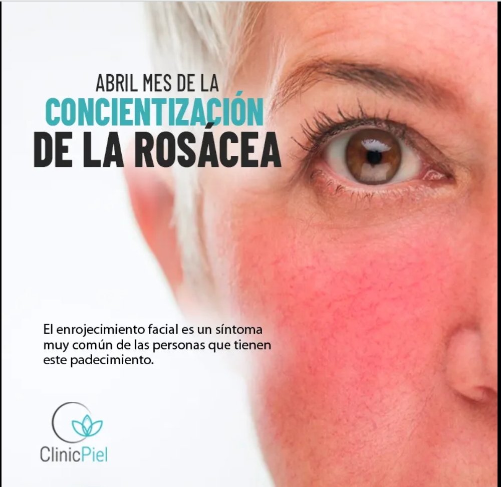 #DiaDeLaRosácea
#Rosácea #DíaMundialDeLaRosácea #27deabril #Dermatólogo