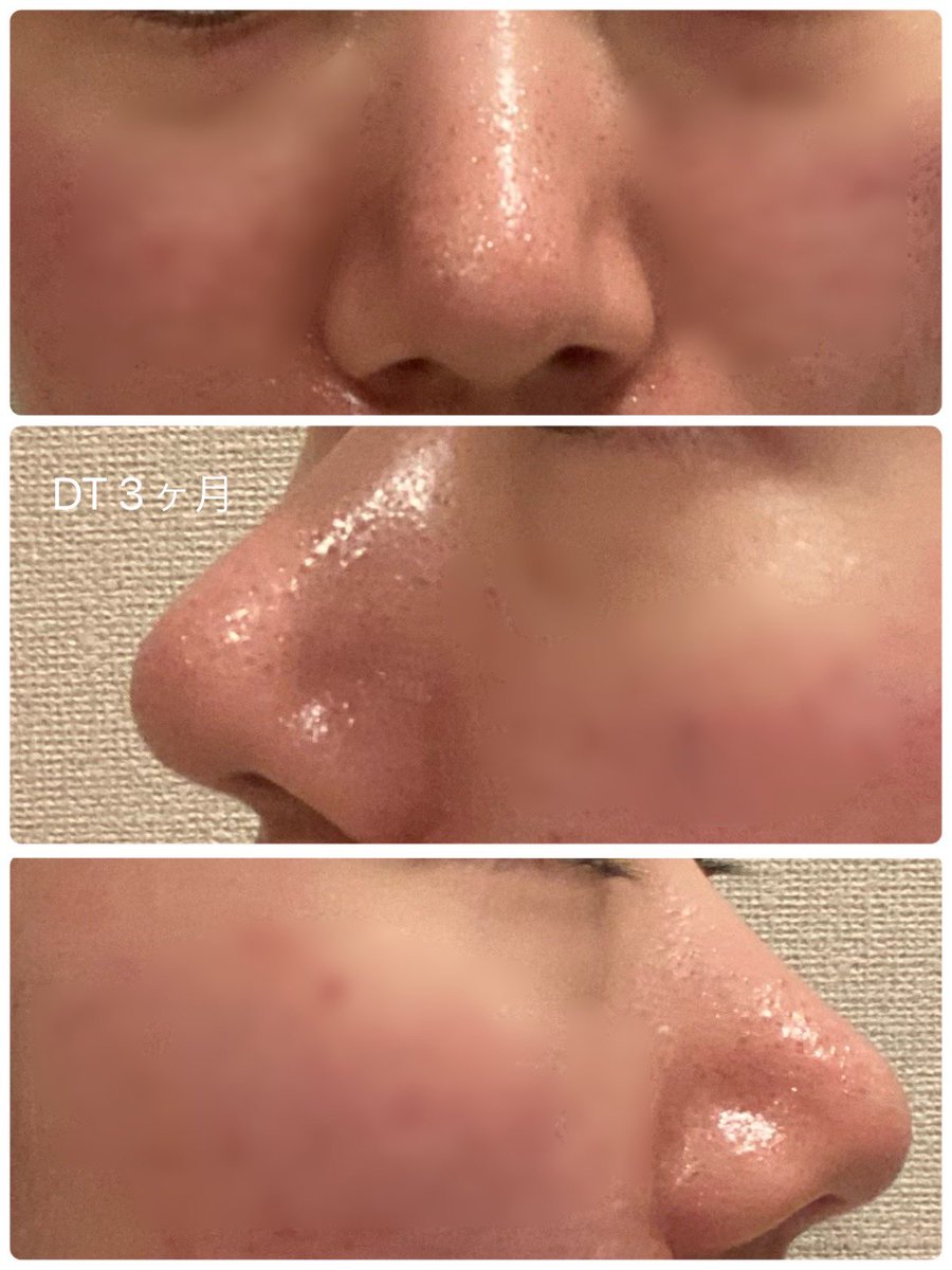 T2vW2's tweet photo. 鼻フル現在３ヶ月をすぎたところです！
２ヶ月と３ヶ月を比較してみました！
機能面は問題なく、鼻先が丸みを帯びてきたなという感じです！
どの角度からも自然な仕上がりで嬉しいです🤍 https://t.co/I0MXSWF2ZV