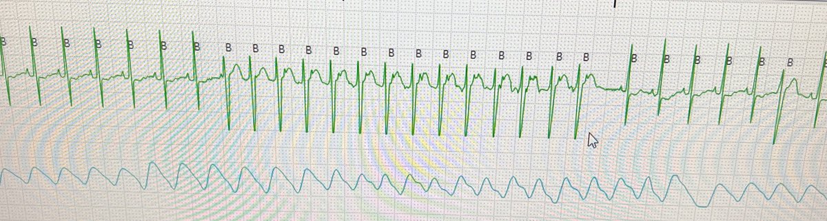 Stefan Kurath-Koller (@kurathkoller) on Twitter photo Monitor tracing from NICU, preterm 1100g. What’s happening here?
<a href="/ManningerMartin/">Martin Manninger</a> <a href="/DanielScherr3/">Daniel Scherr</a> <a href="/melhamriti/">El Hamriti Mustapha</a> <a href="/jeffrey_vinocur/">Jeffrey M Vinocur</a> <a href="/MartinRauber3/">Martin Rauber</a> <a href="/MToumpourleka/">Maria Toumpourleka</a> Monitor tracing from NICU, preterm 1100g. What’s happening here?
<a href="/ManningerMartin/">Martin Manninger</a> <a href="/DanielScherr3/">Daniel Scherr</a> <a href="/melhamriti/">El Hamriti Mustapha</a> <a href="/jeffrey_vinocur/">Jeffrey M Vinocur</a> <a href="/MartinRauber3/">Martin Rauber</a> <a href="/MToumpourleka/">Maria Toumpourleka</a>