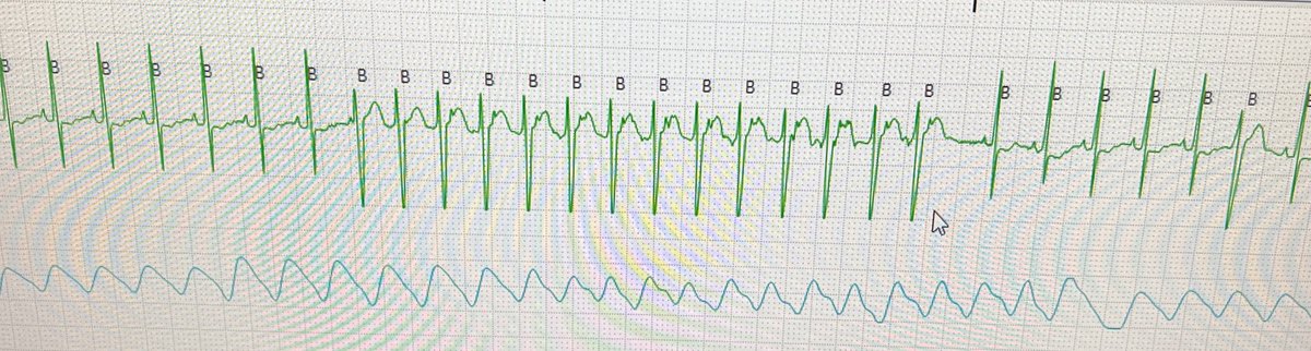 Monitor tracing from NICU, preterm 1100g. What’s happening here? ⁦@ManningerMartin⁩ ⁦@DanielScherr3⁩ ⁦@melhamriti⁩ ⁦@jeffrey_vinocur⁩ ⁦@MartinRauber3⁩ ⁦@MToumpourleka⁩