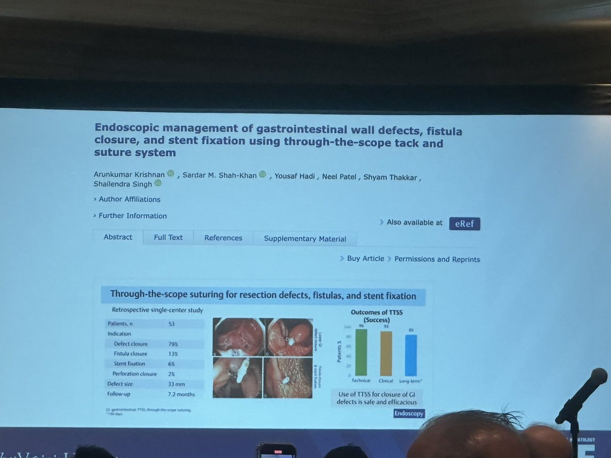 Amazing experience learning from @shailsingh this morning! Very comprehensive overview for endoscopic management of leaks, perforations and fistulas. #WISE2024 #GIendoscopy