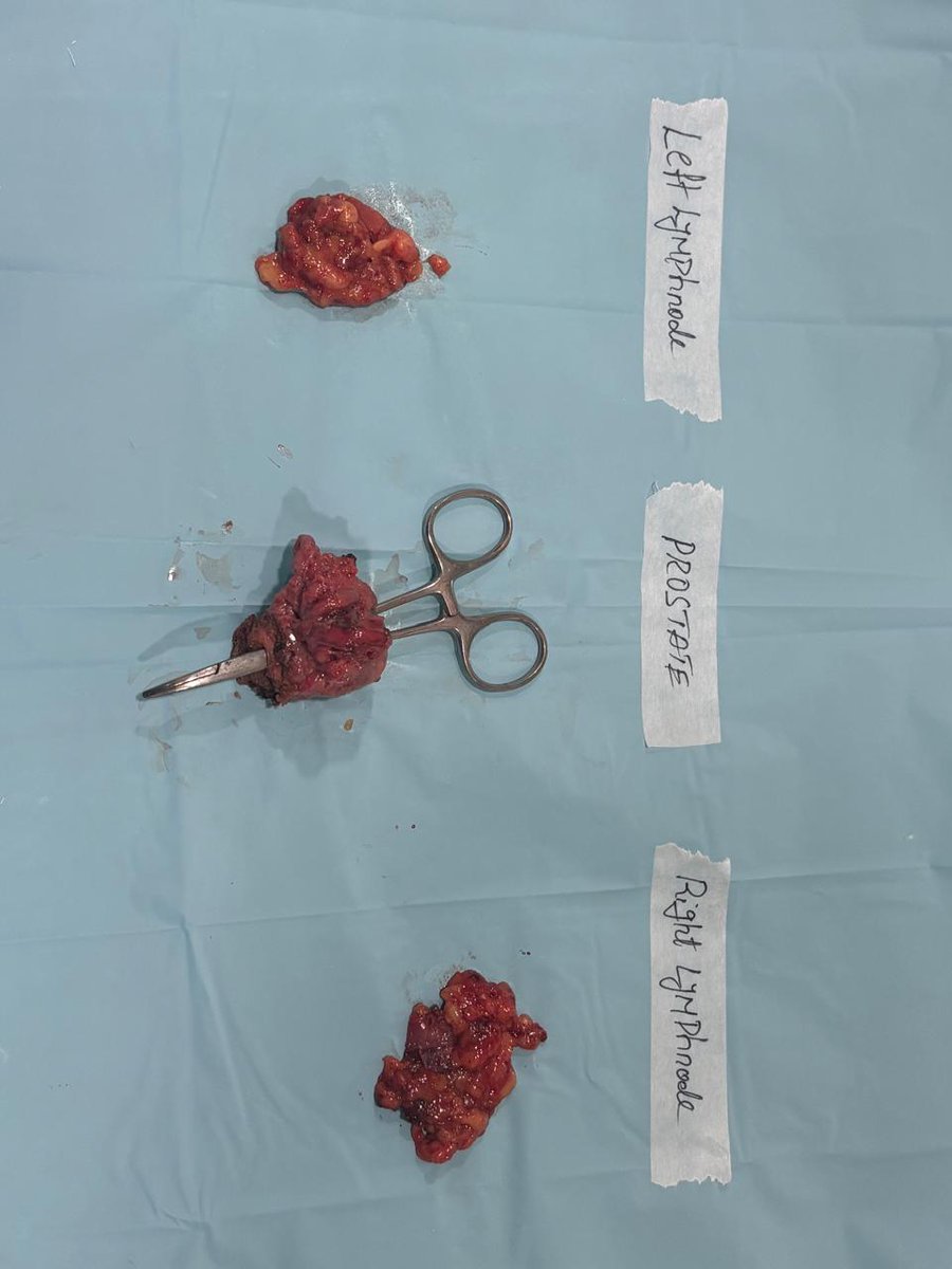 Today I did Robotic Radical Prostatectomy (bilateral nerve sparing) with bilateral lymphadenectomy Grade 3+4, 4/14 cores positive, no extracapsular extension Brief summary Seminal vesicular arteries identified clearly and clipped with metal clips With 0° degree easily could go…