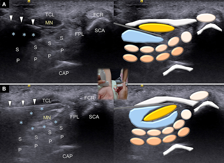 Ultrasound-Guided Triamcinolone Acetonide Hydrodissection for Carpal Tunnel Syndrome: A Randomized Controlled Trial
FREE PDF
frontiersin.org/articles/10.33…